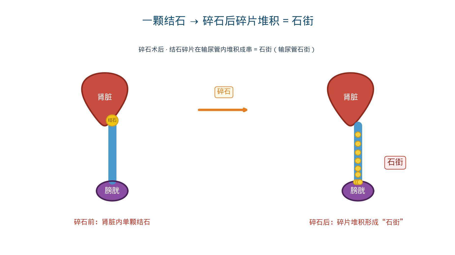 肾结石与石街形成示意图