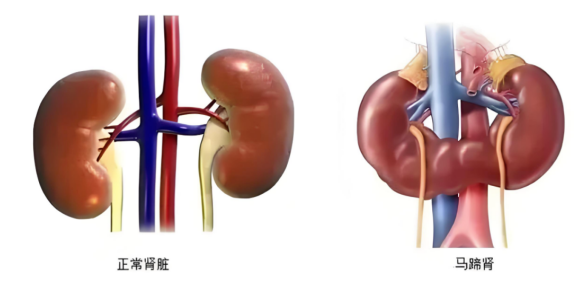 【泌尿外科】结石藏在马蹄肾“连接部”,经皮肾镜手术不带管,术后两天就出院! (6).png 【泌尿外科】结石藏在马蹄肾“连接部”,经皮肾镜手术不带管,术后两天就出院! (6).png